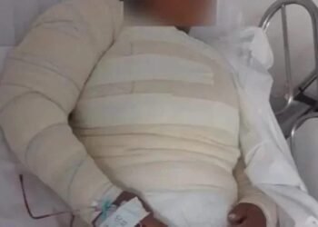 Mulher tem parte do corpo queimado em disputa por terra