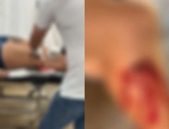 Homem agride mulher com caco de vidro e deixa objeto cravado na perna da vítima em MT